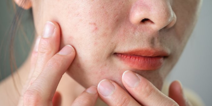 dermato